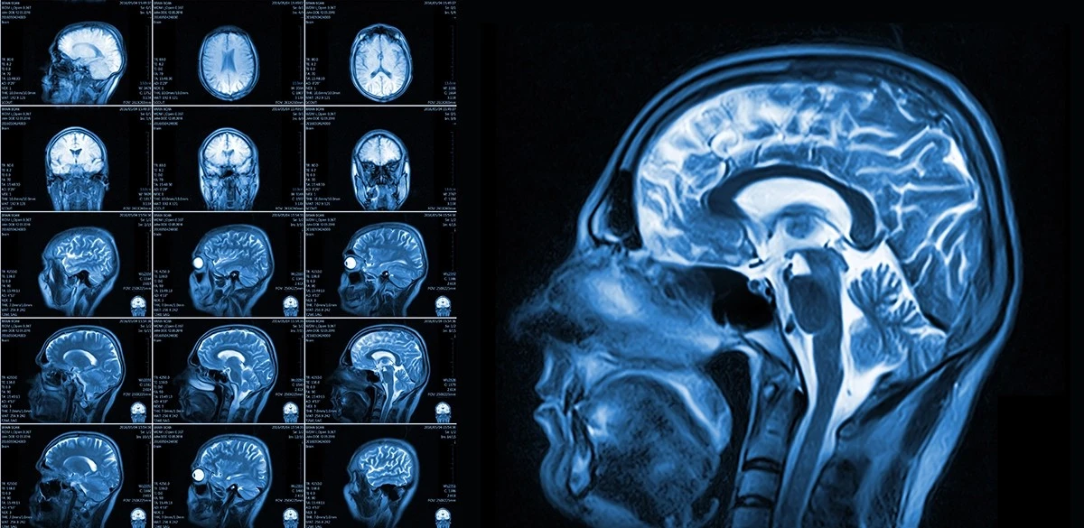 ziewaniezaskaku-extra-1.webp Ziewanie zaskakująco wpływa na Twój mózg, pokazują badania MRI - image 1