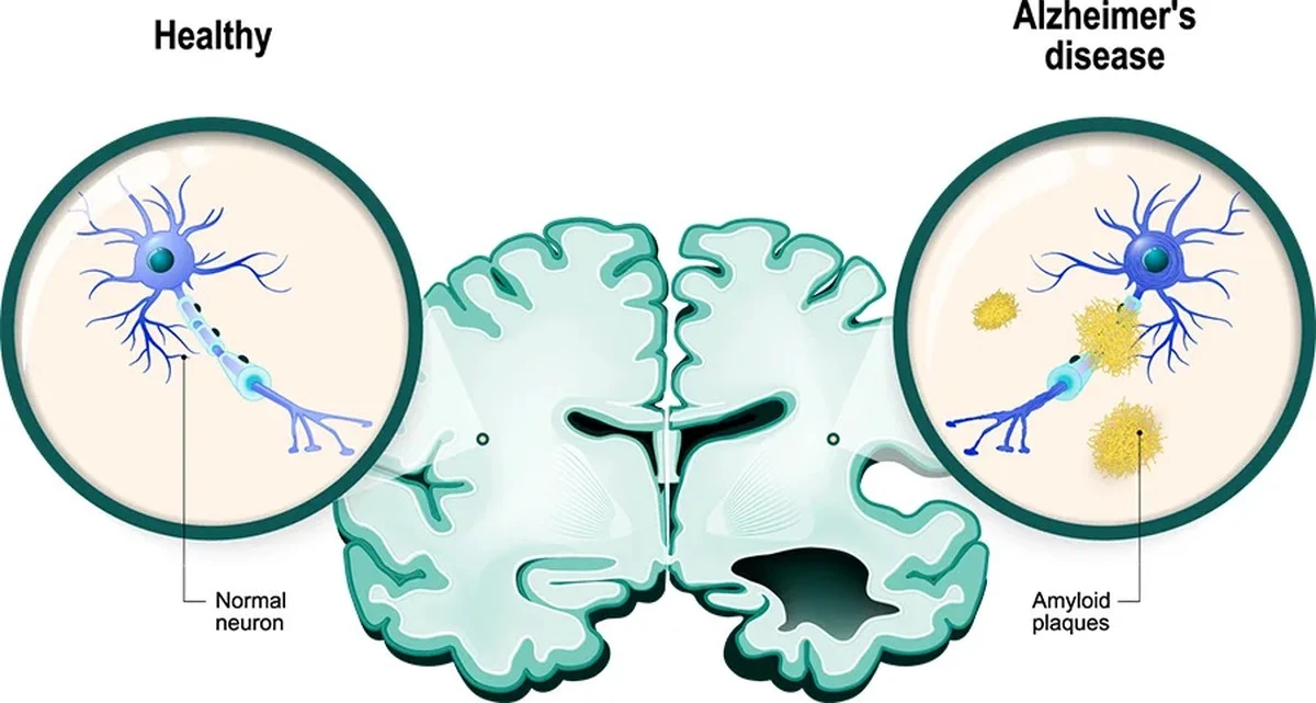 tabletkanasenna-extra-1.webp Tabletka nasenna może spowolnić rozwój Alzheimera: badanie ujawnia zaskakujący związek ze snem - image 1