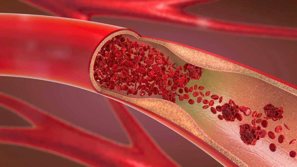 Nowy lek znacząco obniża cholesterol — przełom w badaniach nad chorobami serca