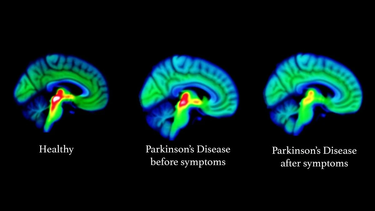 Nowe odkrycie: choroba Parkinsona może mieć źródło w głębszej sieci mózgowej - image 1