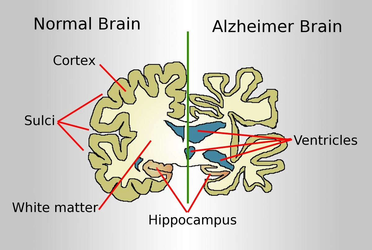 Białko Parkinsona, Kobiety i Zagadka Alzheimera: Nowe Spojrzenie na Nierówność Płci - image 1