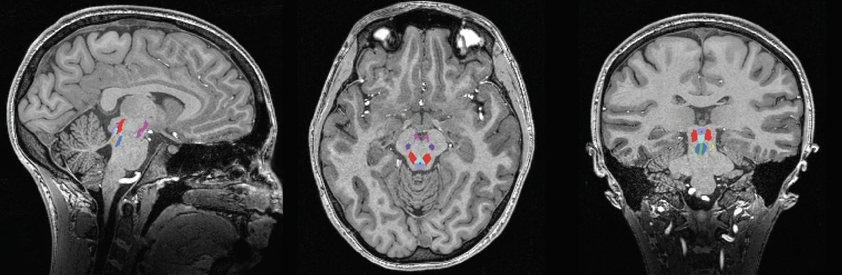 bezsennoscmozeb-extra-1.webp Bezsenność może być wczesnym sygnałem Alzheimera – odkryto nowy mechanizm - image 1