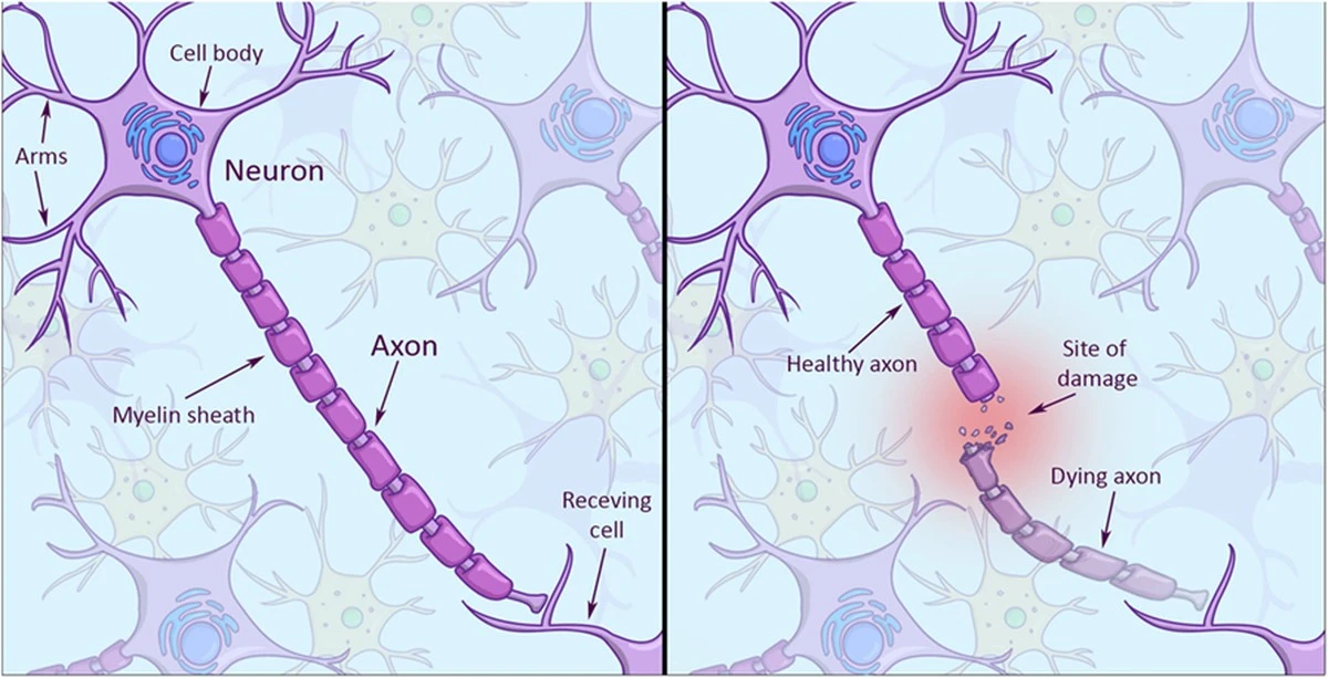 Odkryli kluczowy związek między białkiem Parkinsona a śmiercią komórek mózgowych - image 1